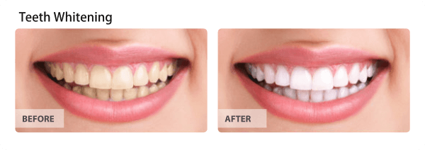 Teeth Whitening Treatment Stanhope Gardens & Padstow